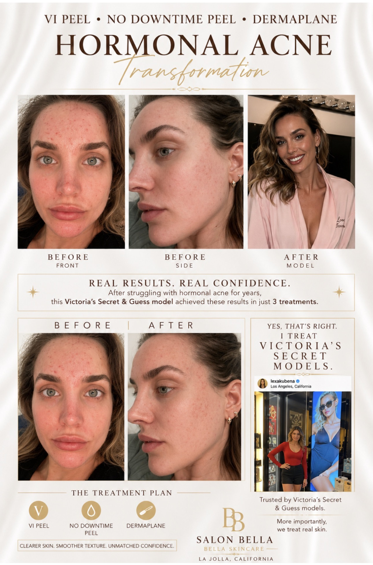 Understanding Acne: Causes, Treatments & Skincare Tips for Clear Skin preview article image