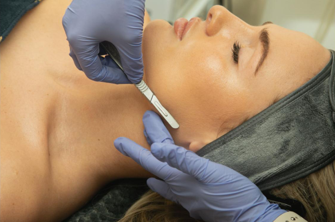 Dermaplanning in La jolla preview article image